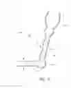 Fig. 14 - Ocular system with anchoring implant and therapeutic agent