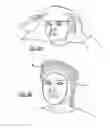 Fig. 07 - WOUND CARE DEVICE