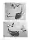 Fig. 05 - Jaw thrust device and method