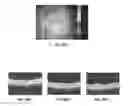 Fig. 61 - Posterior segment drug delivery
