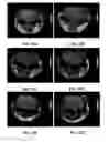 Fig. 20 - MRI imaging of amyloid plaque using liposomes