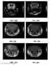 Fig. 21 - MRI imaging of amyloid plaque using liposomes