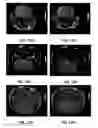 Fig. 22 - MRI imaging of amyloid plaque using liposomes