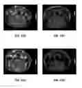 Fig. 23 - MRI imaging of amyloid plaque using liposomes