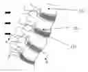 Fig. 01 - METHOD FOR RESTORING A DAMAGED OR DEGENERATED INTERVERTEBRAL DISC