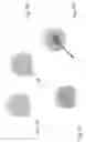 Fig. 04 - METHOD FOR RESTORING A DAMAGED OR DEGENERATED INTERVERTEBRAL DISC
