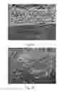 Fig. 09 - METHOD FOR RESTORING A DAMAGED OR DEGENERATED INTERVERTEBRAL DISC