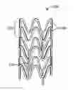 Fig. 01 - Method of treating with poly(L-lactide) stent with tunable degradation rate