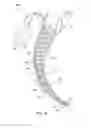 Fig. 02 - PROTECTIVE ENDOTRACHEAL TUBE