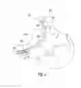 Fig. 06 - PROTECTIVE ENDOTRACHEAL TUBE