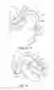Fig. 12 - Laryngeal mask
