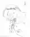 Fig. 03 - Novel airway tube stabilizer