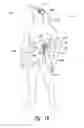 Fig. 03 - DRAINAGE SYSTEMS FOR EXCESS BODY FLUIDS AND ASSOCIATED METHODS