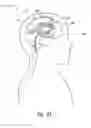 Fig. 09 - DRAINAGE SYSTEMS FOR EXCESS BODY FLUIDS AND ASSOCIATED METHODS