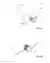Fig. 14 - Percutaneous ports with wire coils