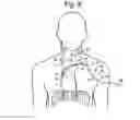 Fig. 06 - Apparatus and methods for assisted breathing by transvascular nerve stimulation