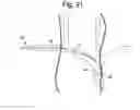Fig. 24 - Apparatus and methods for assisted breathing by transvascular nerve stimulation