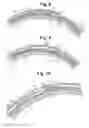 Fig. 05 - Overcap with cutting ring for rigid paper cans