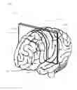 Fig. 17 - BRAIN COMPUTER INTERFACE (BCI) SYSTEM BASED ON GATHERED TEMPORAL AND SPATIAL PATTERNS OF BIOPHYSICAL SIGNALS
