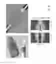 Fig. 32 - ULTRASONIC ARRAY FOR BONE SONOGRAPHY