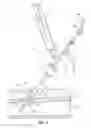 Fig. 05 - Bioresorbable detachable tip design for adhesive-based extravascular closure device