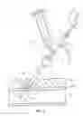 Fig. 06 - Bioresorbable detachable tip design for adhesive-based extravascular closure device