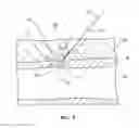 Fig. 08 - Bioresorbable detachable tip design for adhesive-based extravascular closure device