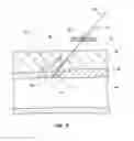 Fig. 09 - Bioresorbable detachable tip design for adhesive-based extravascular closure device