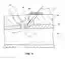 Fig. 10 - Bioresorbable detachable tip design for adhesive-based extravascular closure device