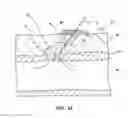 Fig. 13 - Bioresorbable detachable tip design for adhesive-based extravascular closure device