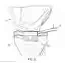 Fig. 10 - System for articular surface replacement