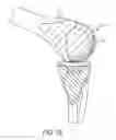 Fig. 16 - System for articular surface replacement