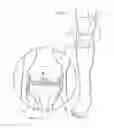 Fig. 02 - ASSEMBLY FOR LIGAMENT REPAIR AND INCLUDING A CUTTING TOOL