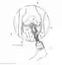 Fig. 03 - ASSEMBLY FOR LIGAMENT REPAIR AND INCLUDING A CUTTING TOOL
