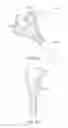 Fig. 12 - Device for removing kidney stones