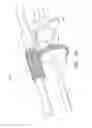 Fig. 22 - Uterine fibroid tissue removal device