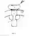 Fig. 06 - SAFETY CANNULA