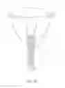 Fig. 04 - METHOD AND DEVICE FOR DISTENDING A GYNECOLOGICAL CAVITY