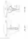 Fig. 64 - METHOD AND DEVICE FOR DISTENDING A GYNECOLOGICAL CAVITY