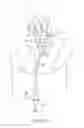 Fig. 15 - Cervical cerclage assistance device