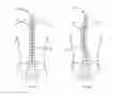 Fig. 04 - Spinal deformity correction