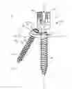 Fig. 01 - Spinal implant system and method