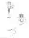 Fig. 12 - Spinal implant system and method