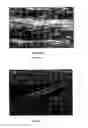 Fig. 07 - Endovascular Treatment Apparatus and Method