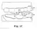 Fig. 03 - Dental appliances with repositioning jaw elements