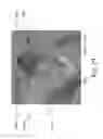 Fig. 23 - Dental appliances with repositioning jaw elements