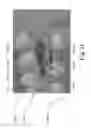 Fig. 25 - Dental appliances with repositioning jaw elements