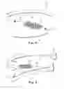 Fig. 11 - SURGICAL ARTICLES AND METHODS FOR TREATING URINARY INCONTINENCE
