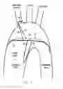 Fig. 04 - INTRAVASCULAR DEVICES