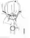 Fig. 11 - Reprogrammable tuneable liquid crystal lens intraocular implant and methods therefor